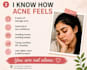 create a personalized acne skin care routine