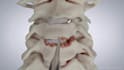 do 3d cervical disc replacement spine surgery animation and medical explainer