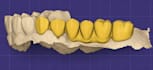 create professional 3d dental cad designs using exocad