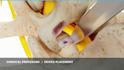 create 3d medical device animation, surgical procedure visualization