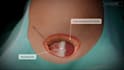 3d medical animation, surgery animation and medical explainer videos
