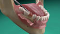 create 3d dental implant, surgery explainer and tooth treatment animation video