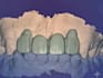 expert dental design on exocad crowns, bridge and more
