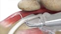 create 3d medical device animation, surgical procedure and orthopedic animation