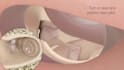 create 3d otosclerosis stapedotomy and ear surgery animation