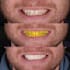 design wax up mock up and veneers using exocad