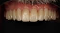 design anatomical crown and bridges using 3shape dental system