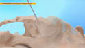 create 3d medical device and surgical implant animation