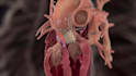 create 3d cardiovascular medical device animation, stent and catheter explainer