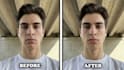 remove pimples and blemishes
