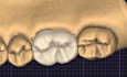 make dental crown design on prepared tooth for you