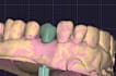make your dental implant crown design