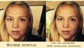 remove acne and scars from your photos