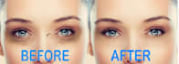 photo retouch, skin retouch, wrinkle and dark circle remove