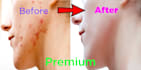 remove pimple and spot from face and body