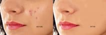 remove wrinkles, blemishes, spots, pimples from your skin