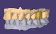 design dental crowns and bridges using exocad