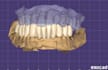 design dental restorations on exocad, dental cad