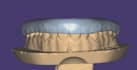 design bite splints and night guards
