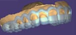 design gingivectomy and bone reduction guide in one in exocad
