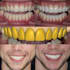 do digital wax up dsd using exocad