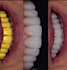 design crown and bridge using exocad