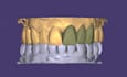 design dental crowns, bridges, implant crowns and partial dentures in exocad