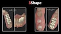 design crown, bridge, and wax up using 3shape software