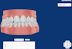 design custom clear aligner treatment plan