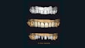 design 3d printed and milled veneers