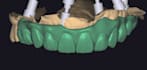 design full arches over implants on exocad