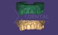 design crowns and bridges in exocad