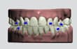 do dental clear aligner treatment planning on archformh and 3shape
