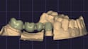 design crowns, bridges, onlays, maryland etc in exocad