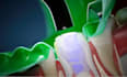medical animation anatomy surgery biomedical animation medical oral implants vid