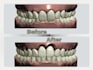 design best clear aligners treatment planning