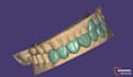 create a high quality digital smile design in exocad first crown free