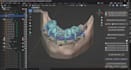 do implant planning, surgical guides, and stackable guides
