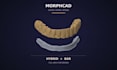 design custom dental implant bars and ibars in exocad