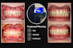 do predictable clear aligners treatment planning