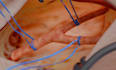 do 3d medical animation for surgical procedure, moa, healthcare explainer video