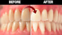 edit your teeth, align, whiten teeth, and remove braces