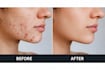 remove professionally acne or retouching your photos