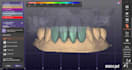 create accurate dental prosthesis designs using exocad