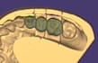 design crowns, bridges, veneers and implants using exocad