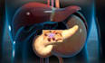 create 3d medical device animation, 3d medical explainer video