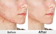 remove pimples and dark spots from the face and body