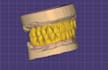 design crown and bridge using exocad