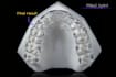 design dental splints in exocad ready for 3d printing