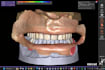 design digital total prostheses using exocad